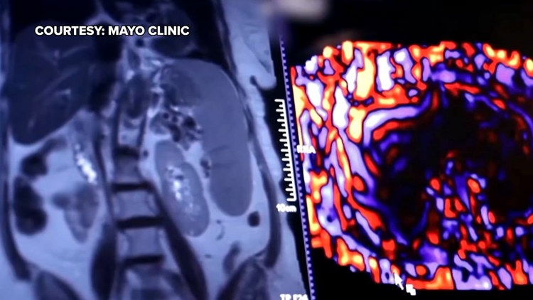 Healthy SA: Battling liver cancer, a disease which often has no symptoms early on — KENS 5 (San Antonio), Piedmont Health news